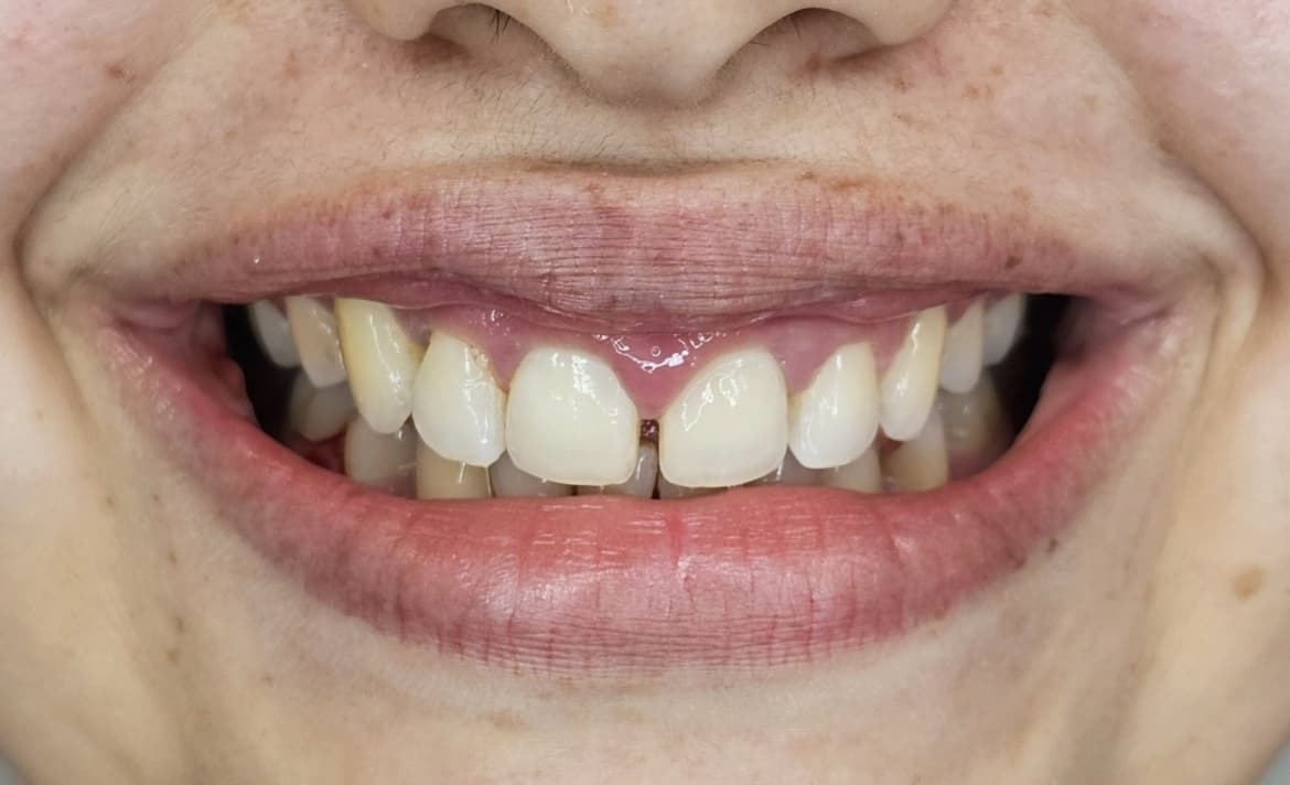 Sonrisa del paciente antes del tratamiento