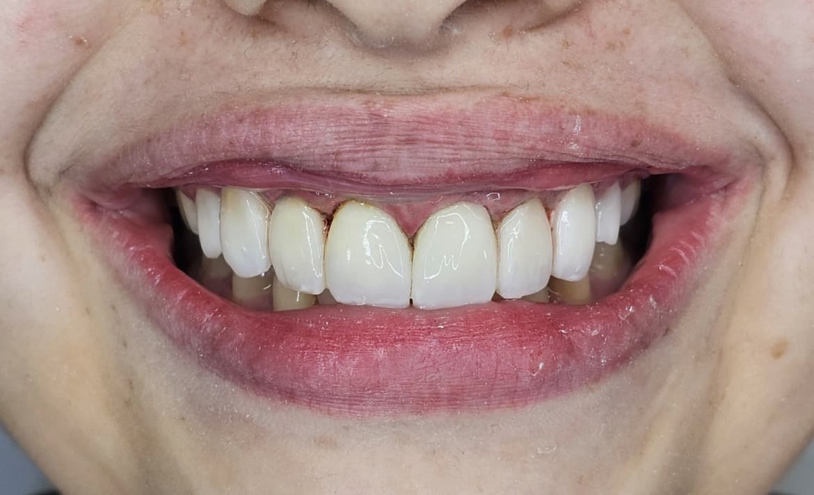 Sonrisa del paciente después del tratamiento