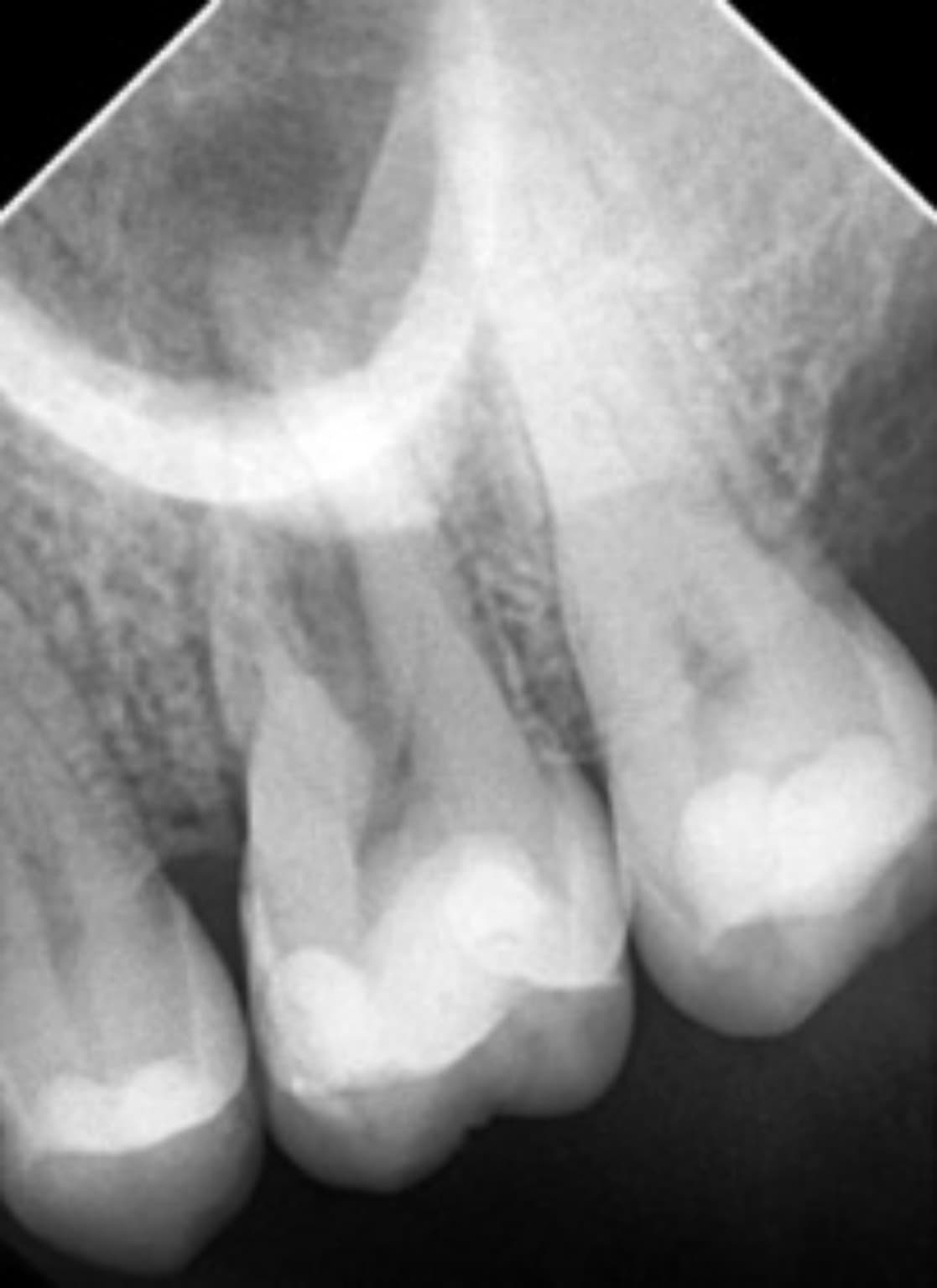 Radiografía periapical antes del tratamiento de endodoncia