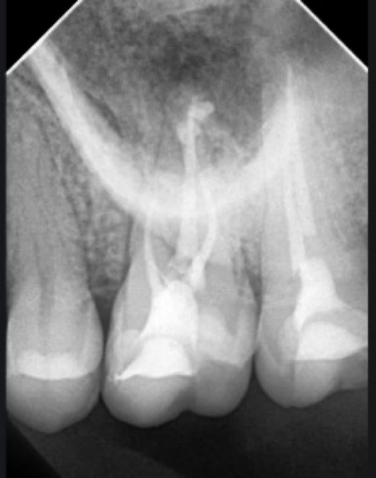 Radiografía periapical después del tratamiento de endodoncia