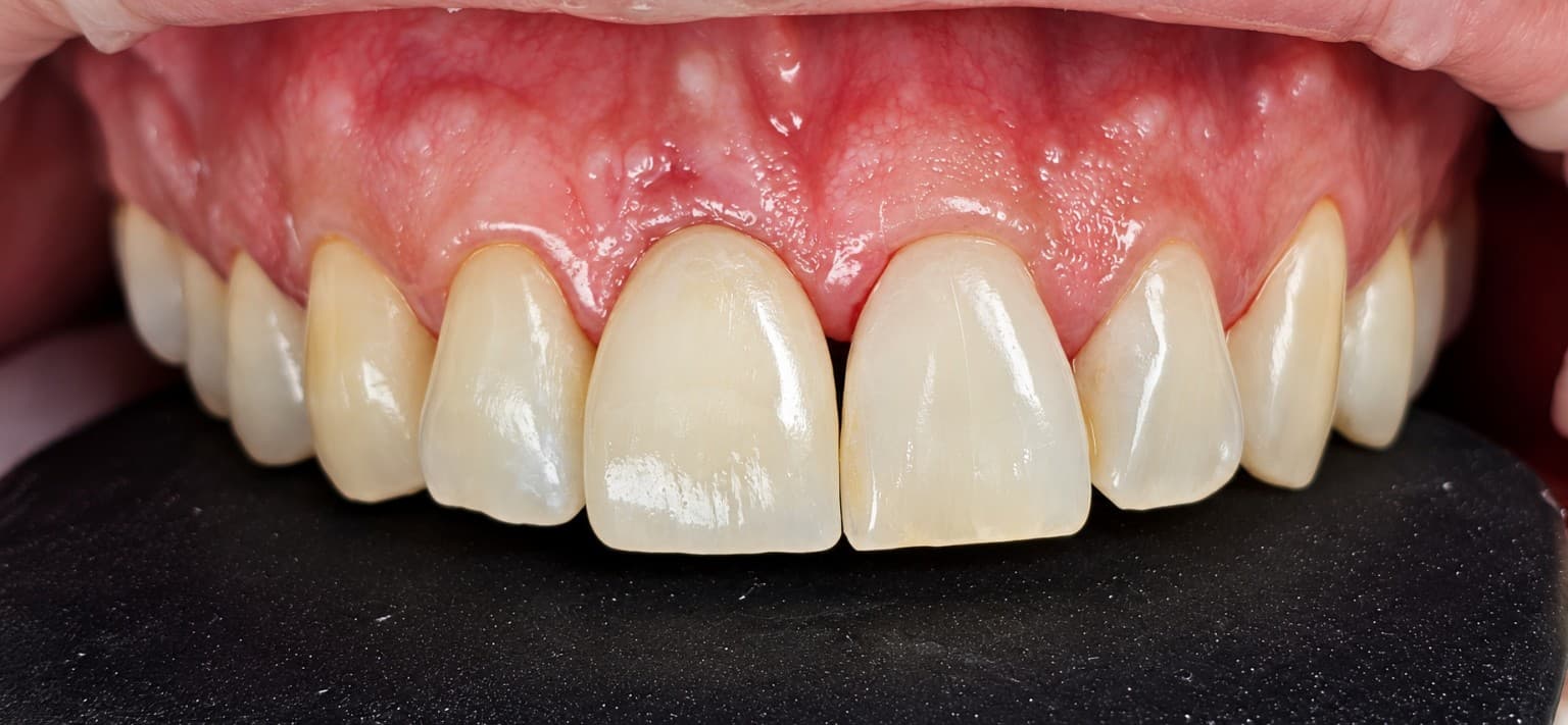 Resultado final con corona definitiva de porcelana (zirconio) en la pieza 11